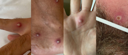 Man tests positive for monkeypox, HIV and Covid all at once