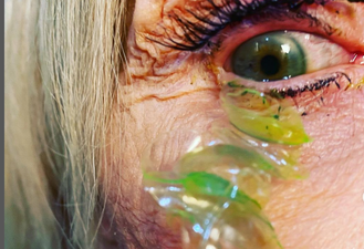 Doctor removes 23 contact lenses from patient’s eye