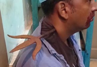 Man survives having a 1.5ft trident stabbed through his neck during work row – and even tells doctors it didn’t hurt