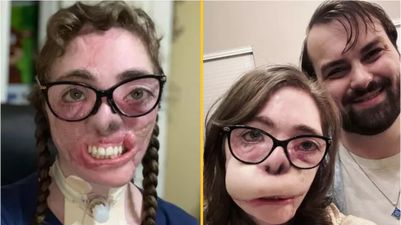 Dogsitter reveals results of reconstructive surgery after most of her face was torn off in dog attack
