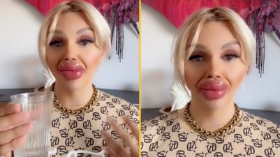 Woman who’s undergone huge lip injections says it’s difficult to eat and drink