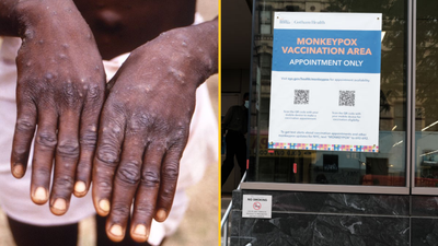 Mpox symptoms to be aware of as WHO declares ‘global emergency’