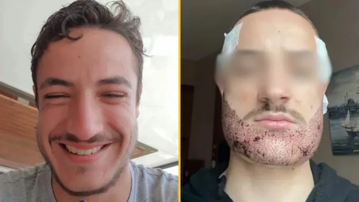 Student takes own life after Turkey beard transplant by 'estate agent ...