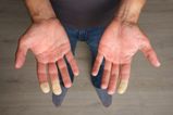Millions of Brits suffer common disease where fingers turn white during winter months