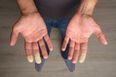 Millions of Brits suffer common disease where fingers turn white during winter months
