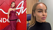 Katie Piper issues update on eye health after having it sewn shut for a year