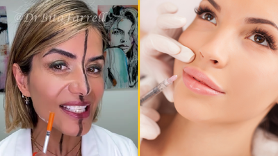 Doctor shares side effects of Botox after injecting only one side of her face