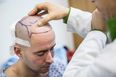 Scientists claim they can cure baldness
