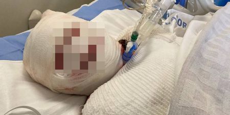 Woman’s face ‘falls off’ after horrific reaction to taking ibuprofen