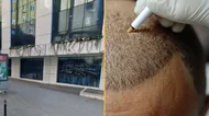 Brit tourist dies in Turkey after hair transplant goes wrong
